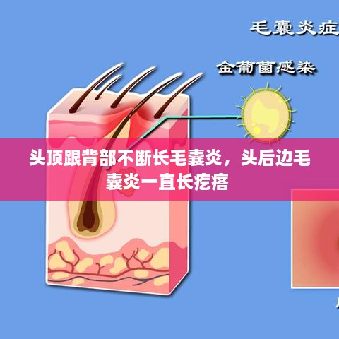 头顶跟背部不断长毛囊炎，头后边毛囊炎一直长疙瘩 