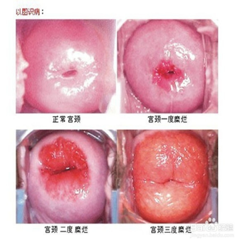 青春期宫血治疗方法探讨