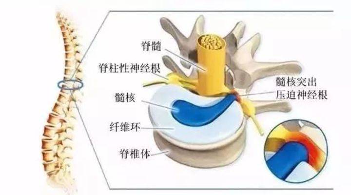 11月2日根线虫最新根治法详解，有效治疗根线虫的方法与解析