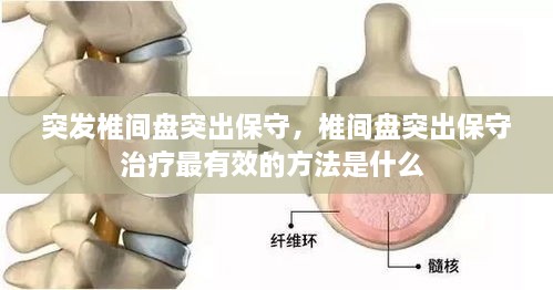 突发椎间盘突出保守，椎间盘突出保守治疗最有效的方法是什么 